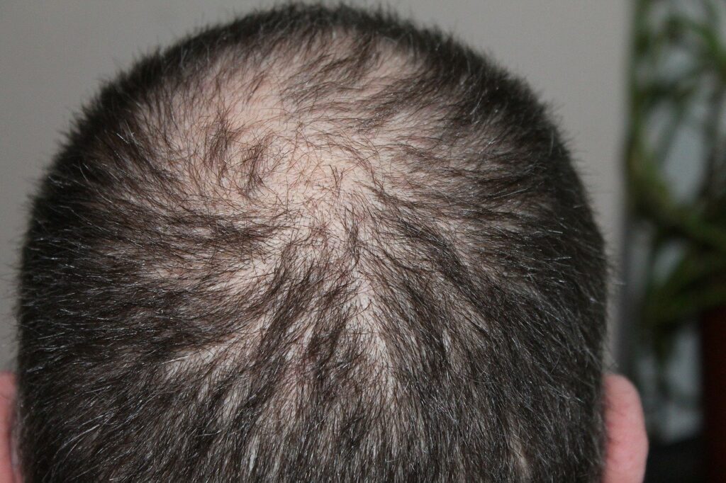 L’utilisation du Minoxidil